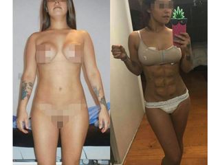 Antes y después de Liposucción HD