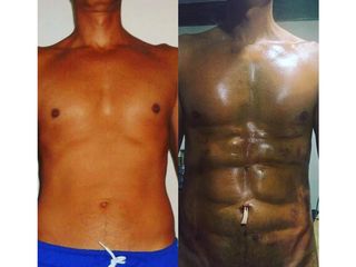 Antes y después de Liposucción HD