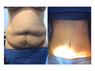 Antes y después de Abdominoplastia