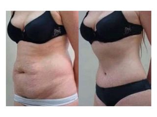 Antes y después de Liposucción
