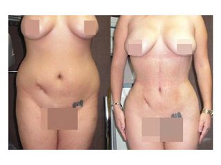 Antes y después de Liposucción
