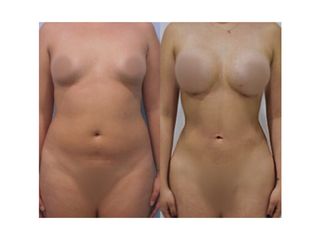 Antes y después de Liposucción