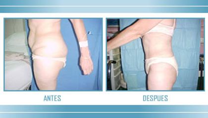 Antes y después de Liposucción