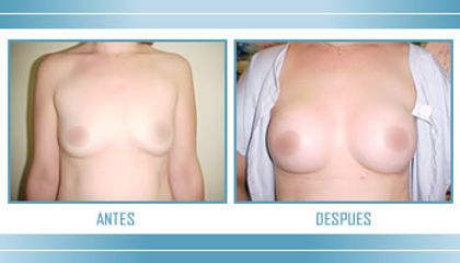 Antes y después de Aumento de busto