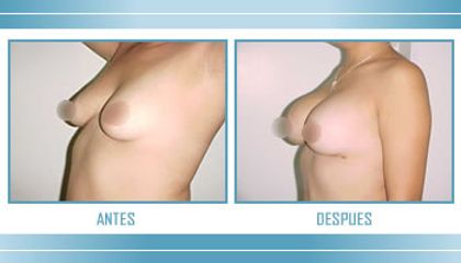 Antes y después de Aumento de busto