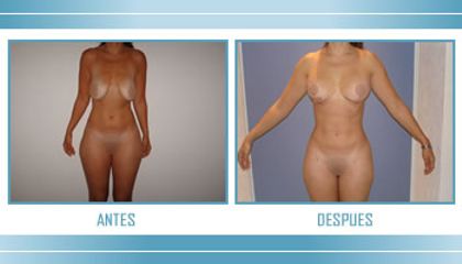 Antes y después de Aumento de busto