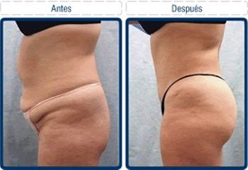 Antes y después de Abdominoplastia