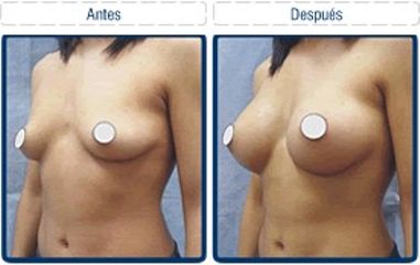 Antes y después de Aumento de busto