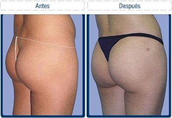 Antes y después de Gluteoplastia