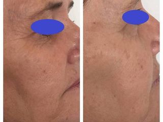 Antes y después de tratamiento de rejuvenecimiento facial