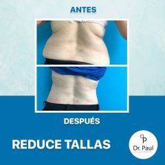 Antes y después de Mesoterapia