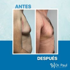 Antes y después de Ginecomastia