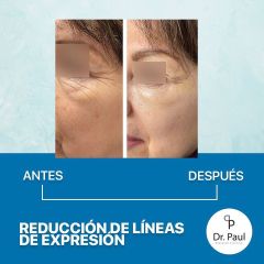 Antes y después de Rejuvenecimiento facial