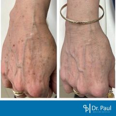 Antes y después de Manchas en la piel