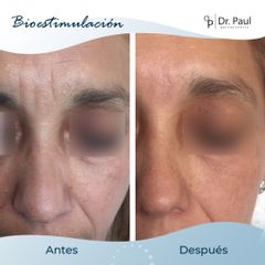 Rejuvenecimiento facial - Dr. Paul Medicina Estética