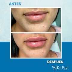 Aumento de labios - Dr. Paul Medicina Estética