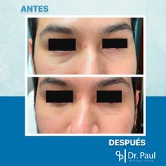 Eliminación de ojeras - Dr. Paul Medicina Estética
