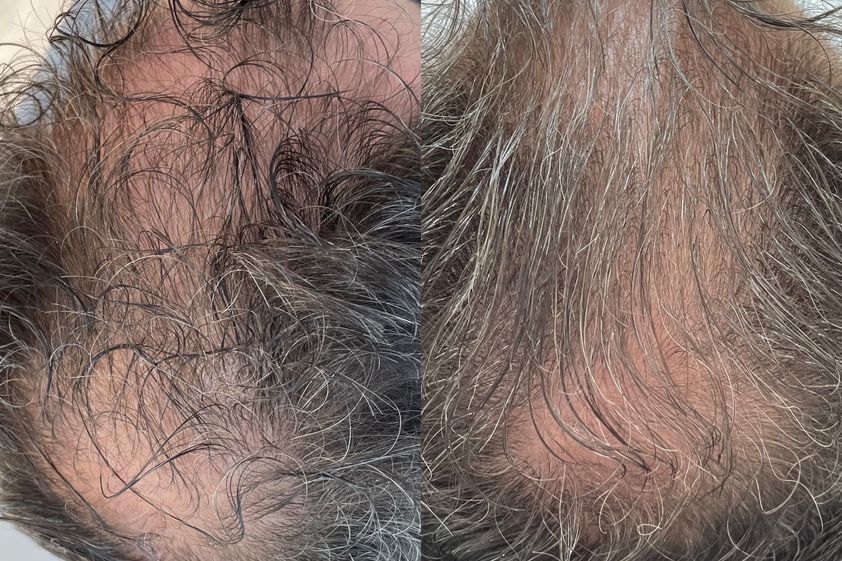 Alopecia antes y después - 836216