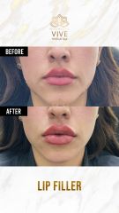 Aumento en labios - Vive Spa Médico