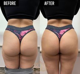 Butt filler - Vive Spa Médico