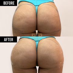 Relleno de glúteos - Vive Spa Médico