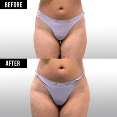 Hip filler y butt filler