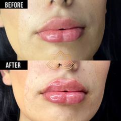 Relleno de labios con juvederm ultra plus por dr. Darío