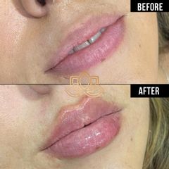 Relleno de labios con aido hialurónico 1 jeringa - Dra Ileana