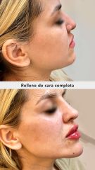 Procedimiento full-face - Vive Spa Médico