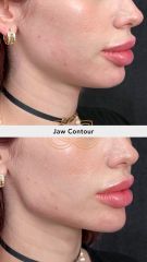 Jaw contour - Vive Spa Médico