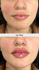 Relleno de labios con ácido hialurónico