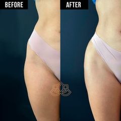 Hip filler - Vive Spa Médico
