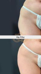 Relleno de caderas con Ácido hialurónico - Vive Spa Médico