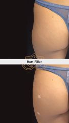 Relleno de glúteos - Vive Spa Médico