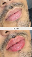 Aumento de labios - Vive Spa Médico