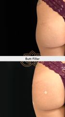 Relleno de glúteos - Vive Spa Médico