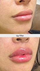 Aumento de labios - Vive Spa Médico