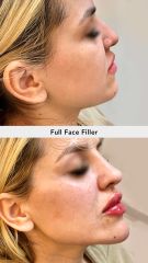 Ácido Hialurónico (Full Face Filler) - Vive Spa Médico