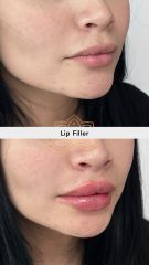 Aumento de labios (Lip Filler) - Vive Spa Médico
