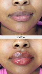 Aumento de labios ( Lip Filler) - Vive Spa Médico