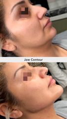 Jaw Contour (Acido hialuronico) - Vive Spa Médico