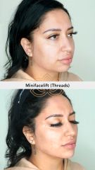 Minifacelift (Threads) Hilos Tensores - Vive Spa Médico