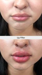 Lip Filler (Aumento de labios) - Vive Spa Médico