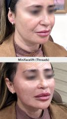 Minifacelift(Theads) Hilos tensores - Vive Spa Médico