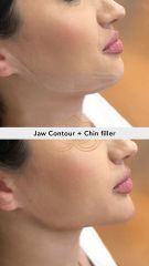 Acido hilauronico (Jaw Contour+ Chin Filler) - Vive Spa Médico