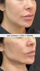 Acido hialuronico (Jaw Contour+ Chin+ Cheeks) -Vive Spa Médico