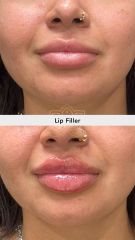 Aumento de labios before & after- Vive Spa Médico