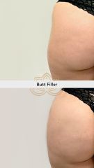Acido hialuronico (Butt Filler) - Vive Spa Médico