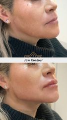Acido hialuronico (Jaw Contour) - Vive Spa Médico