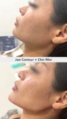 Acido hilauronico (jaw+chin) Before & After - Vive Spa